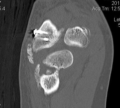 Elbow CT Posterior HO